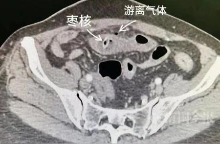柳州女子因一杯养生茶肠穿孔，医生警告：这样做很危险！